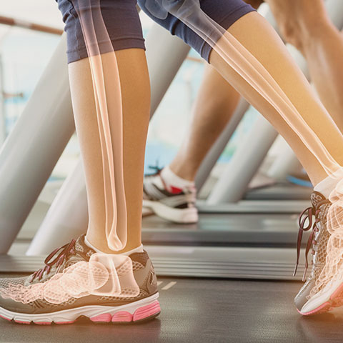 Für normale Knochen Markierte Knochen in Beinen auf Laufband