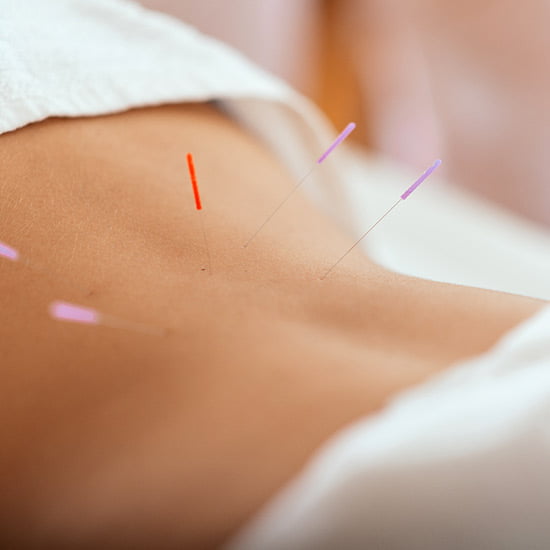 Akupunkturnadeln im Rücken einer Frau